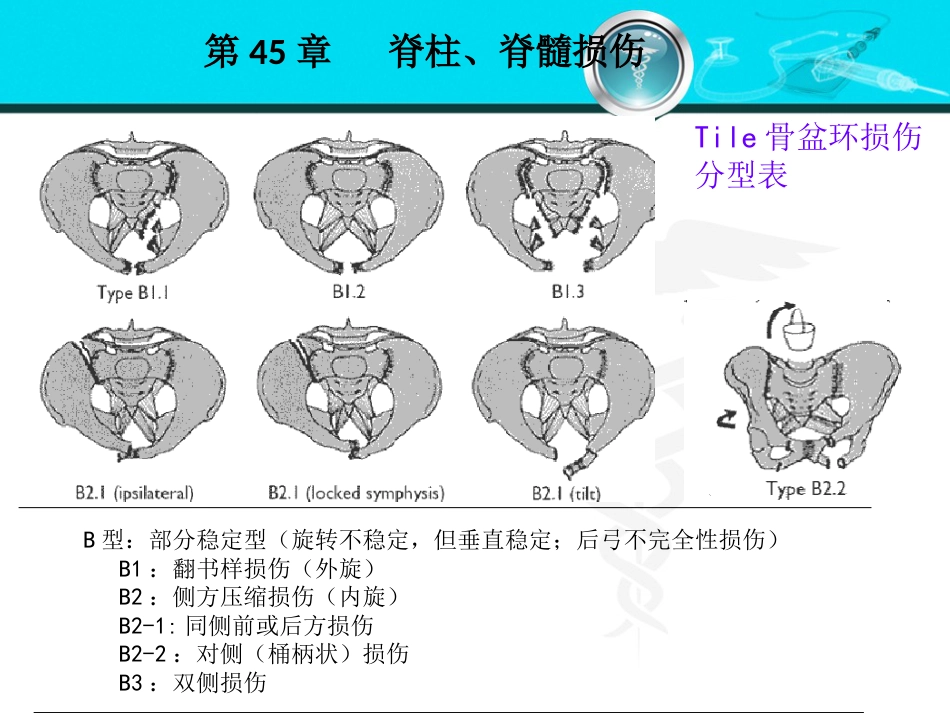 骨盆髋臼骨折_第6页