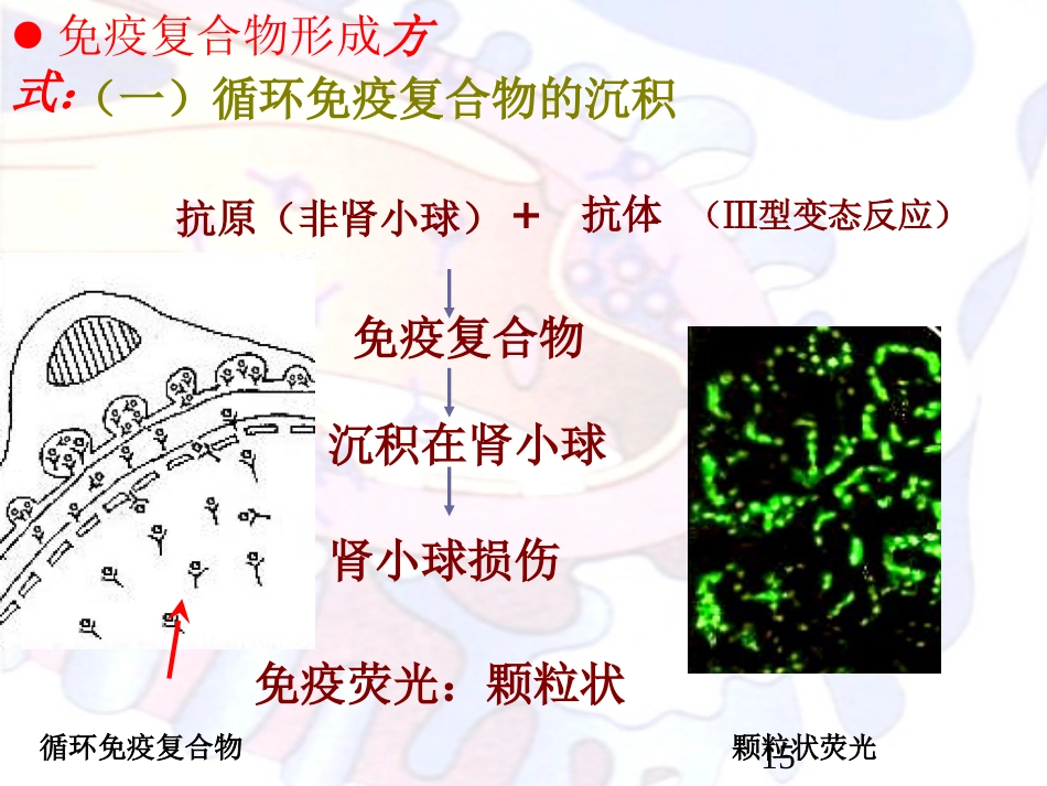 病理学泌尿系统疾病_第13页