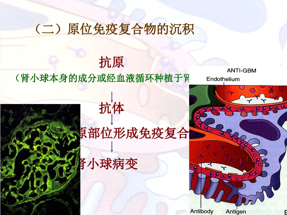 病理学泌尿系统疾病_第14页