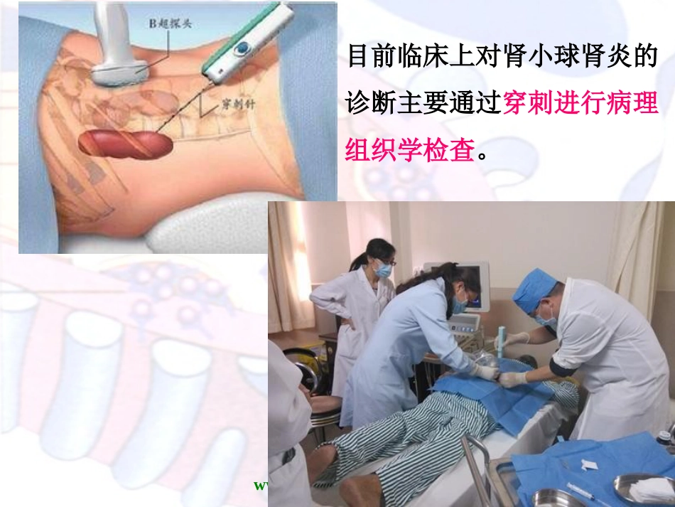 病理学泌尿系统疾病_第8页