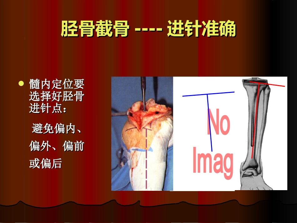 TKA中软组织平衡的原则_第10页