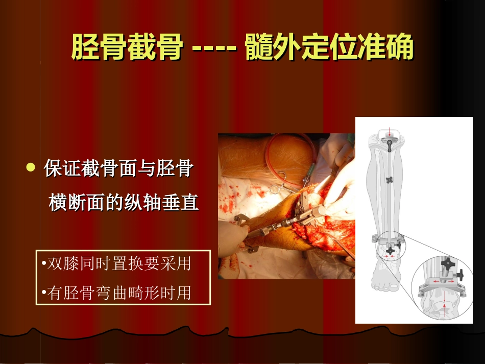 TKA中软组织平衡的原则_第11页