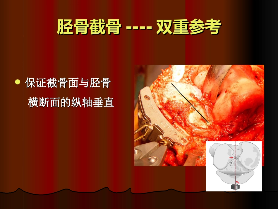 TKA中软组织平衡的原则_第12页