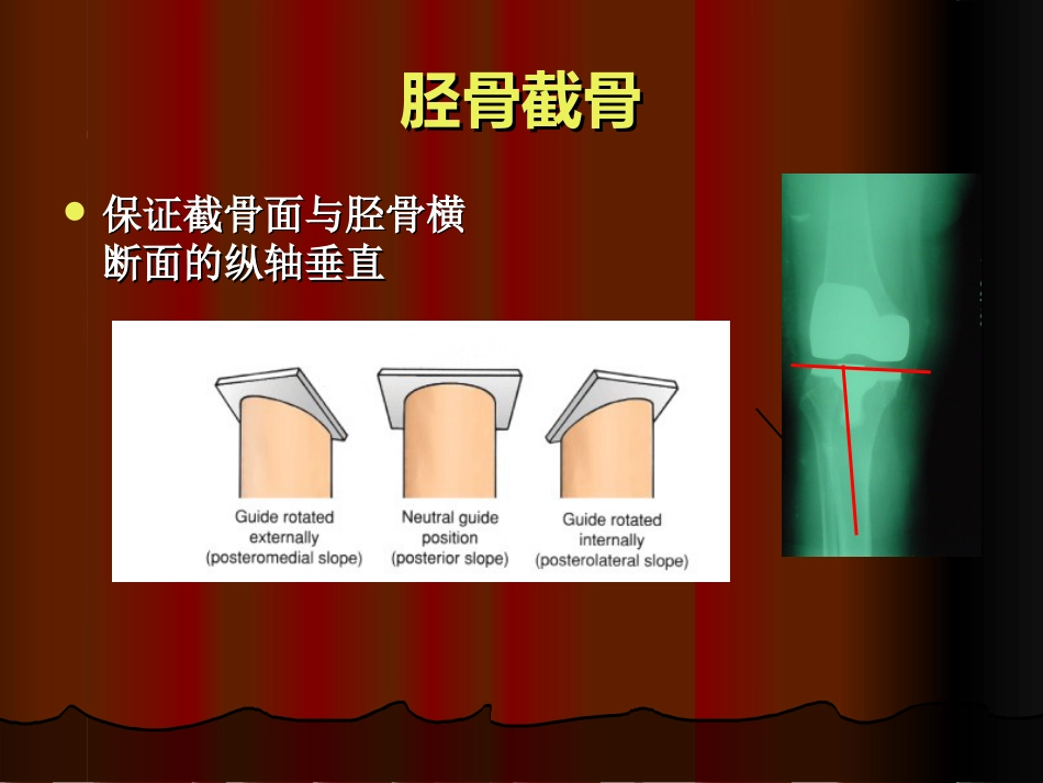 TKA中软组织平衡的原则_第13页