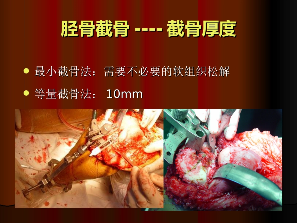 TKA中软组织平衡的原则_第14页