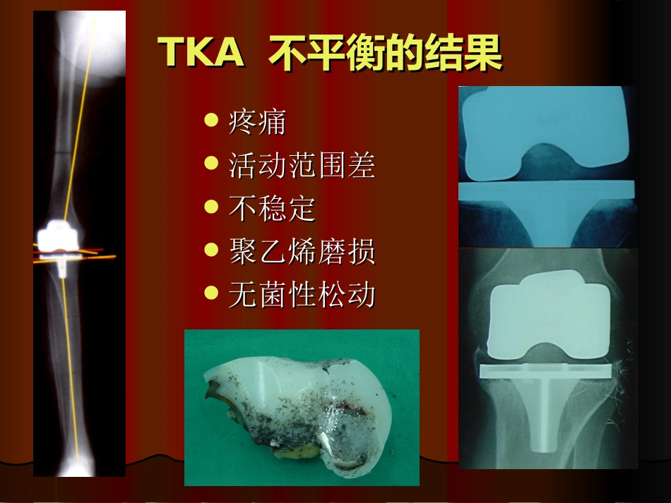 TKA中软组织平衡的原则_第2页
