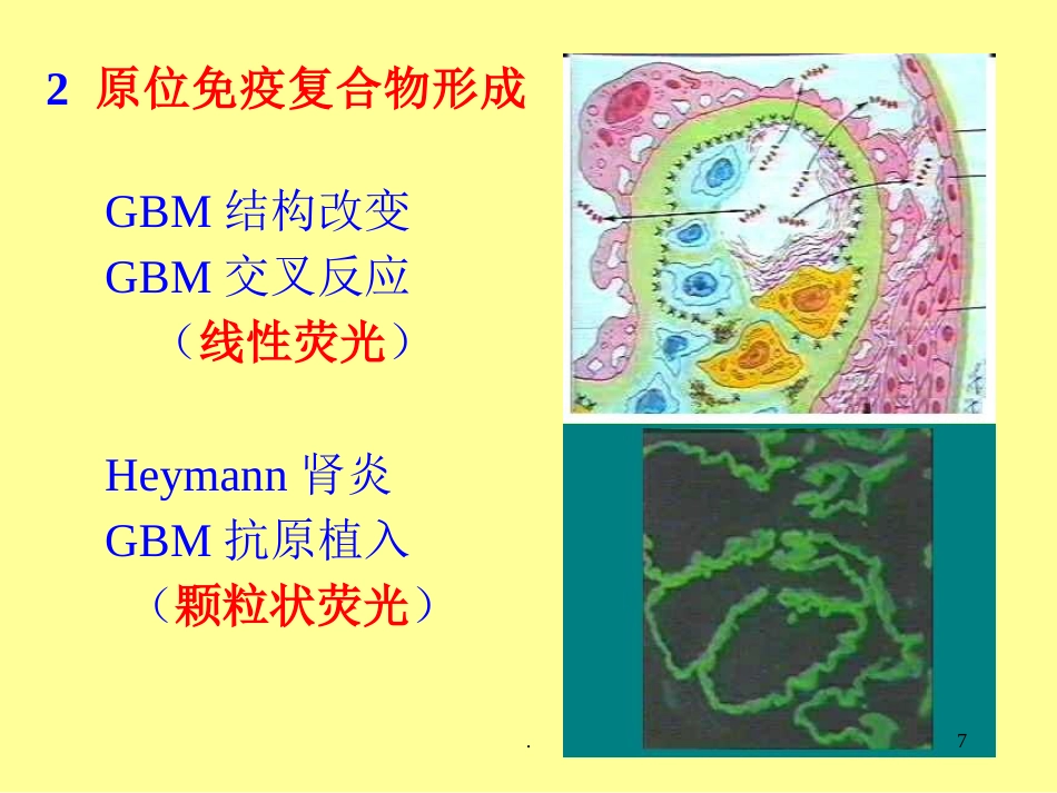病理学泌尿系统疾病ppt课件ppt演示课件_第7页