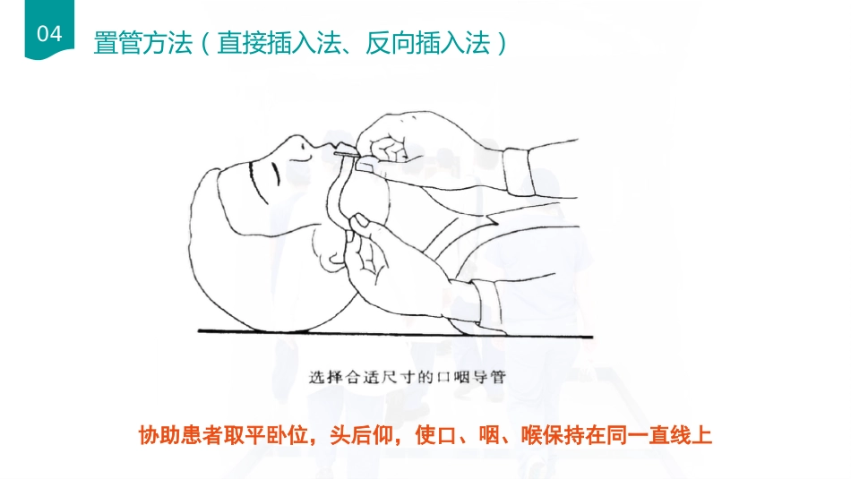 口咽通气放置方法_第6页