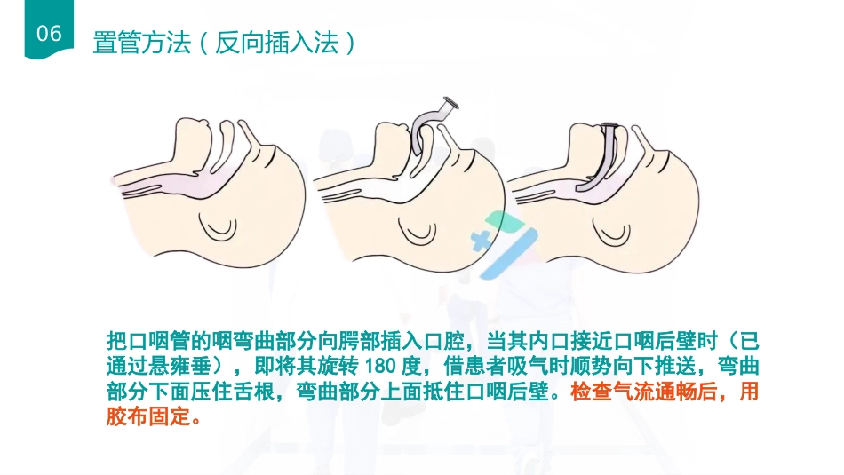 口咽通气放置方法_第8页