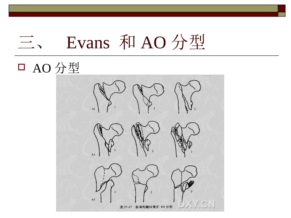 股骨粗隆间骨折PPT_第11页