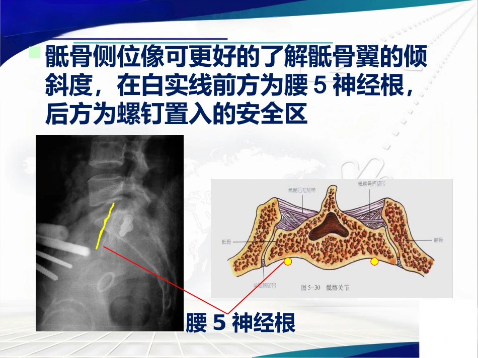 骨盆髋臼骨折的微创治疗_第12页