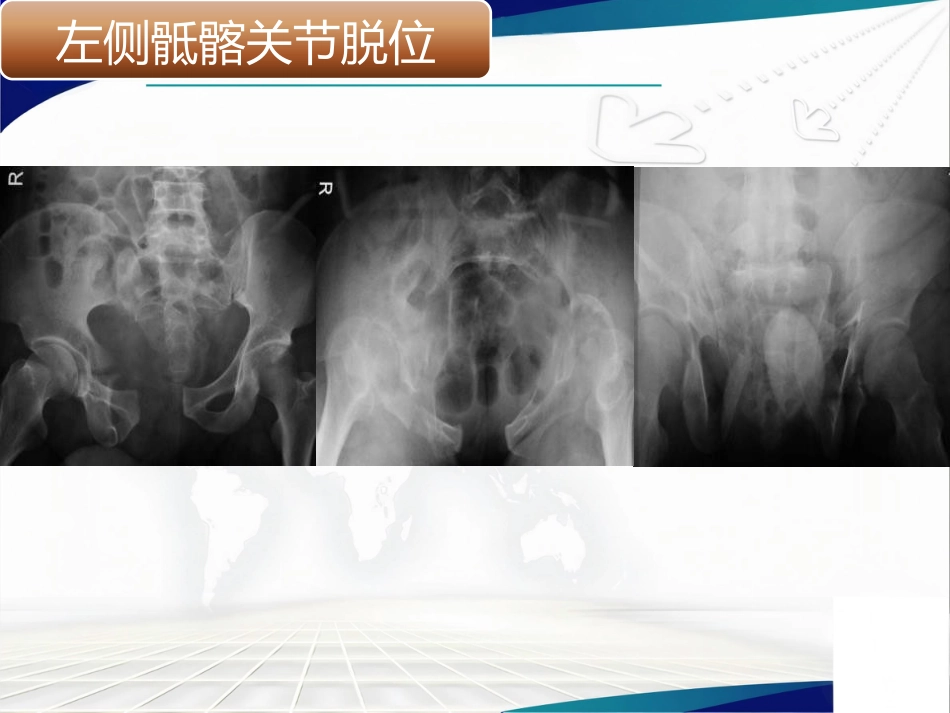 骨盆髋臼骨折的微创治疗_第2页