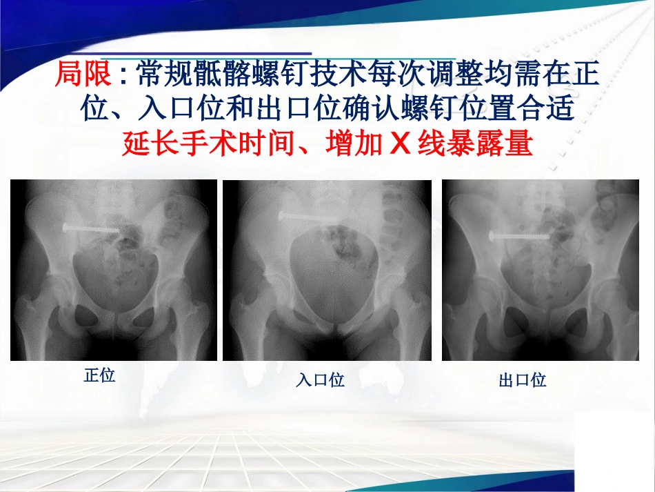 骨盆髋臼骨折的微创治疗_第5页