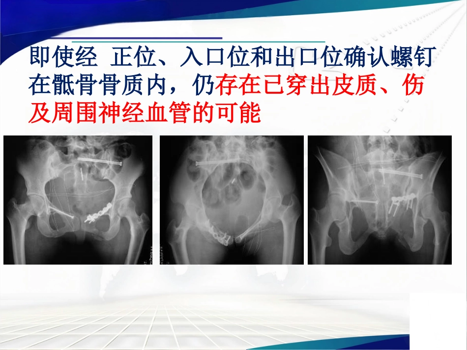 骨盆髋臼骨折的微创治疗_第6页