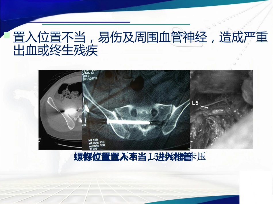 骨盆髋臼骨折的微创治疗_第7页
