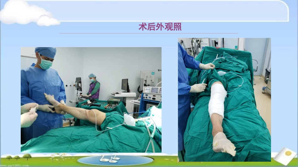 HTO治疗前交叉韧带损伤伴屈曲挛缩畸形--ppt课件_第12页