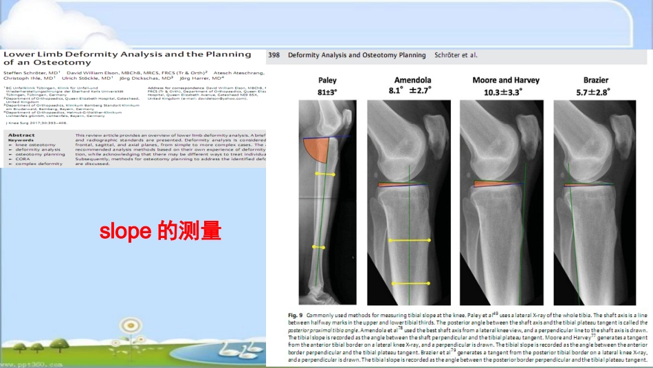 HTO治疗前交叉韧带损伤伴屈曲挛缩畸形--ppt课件_第14页