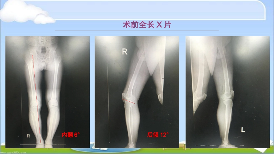 HTO治疗前交叉韧带损伤伴屈曲挛缩畸形--ppt课件_第4页