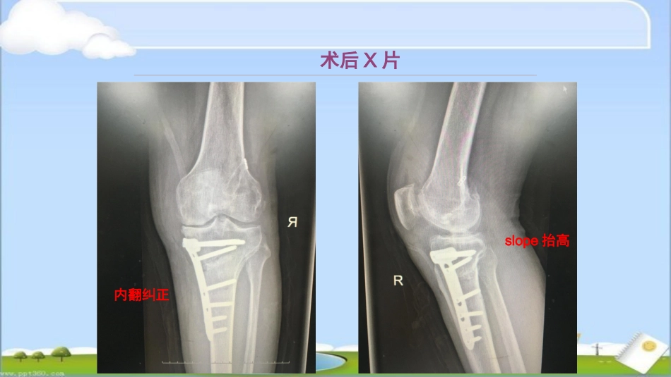 HTO治疗前交叉韧带损伤伴屈曲挛缩畸形--ppt课件_第9页