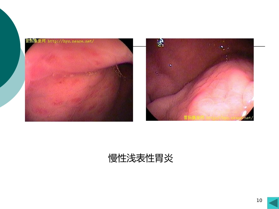 病理学课件PPT 消化系统疾病_第10页