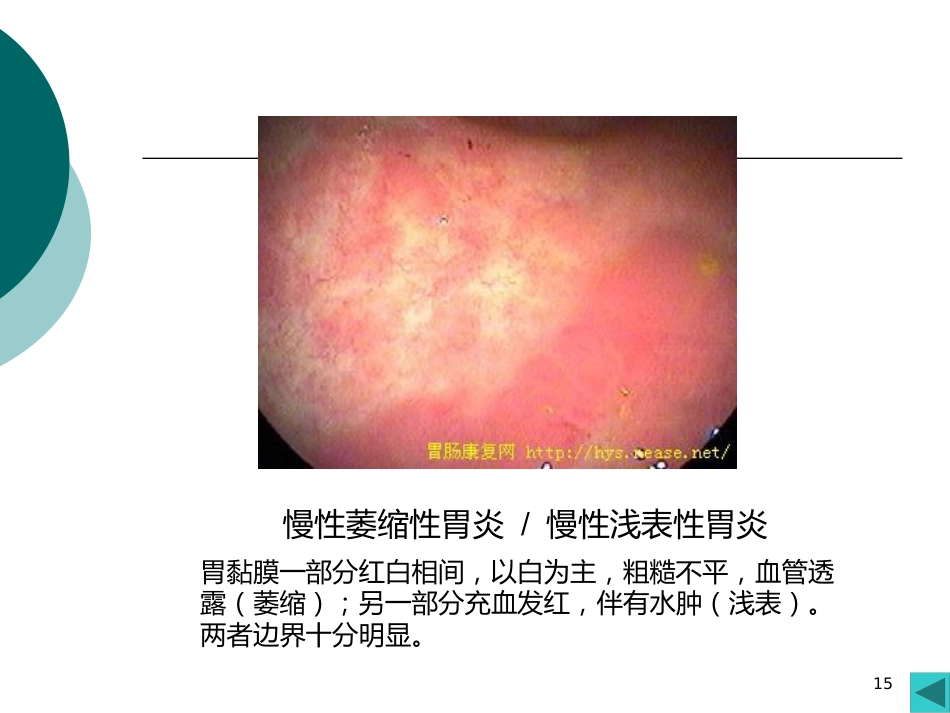 病理学课件PPT 消化系统疾病_第15页