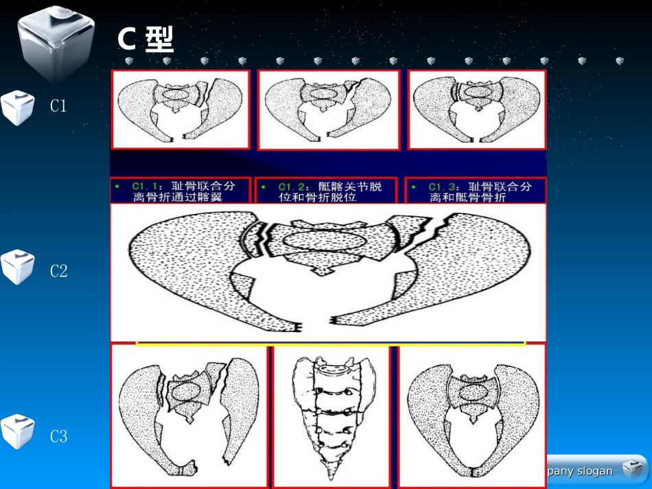 骨盆骨折的分型及治疗_第14页