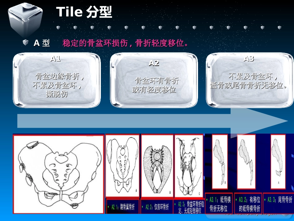 骨盆骨折的分型及治疗_第9页