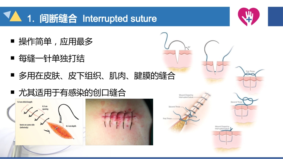 缝合与拆线_第13页