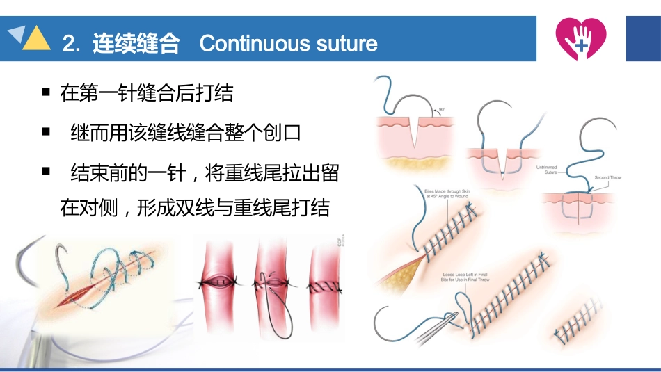 缝合与拆线_第14页