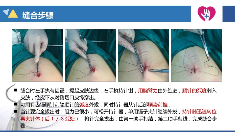 缝合与拆线_第9页