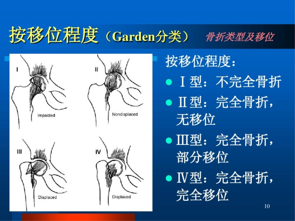股骨颈骨折ppt课件_第10页