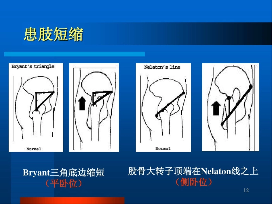股骨颈骨折ppt课件_第12页