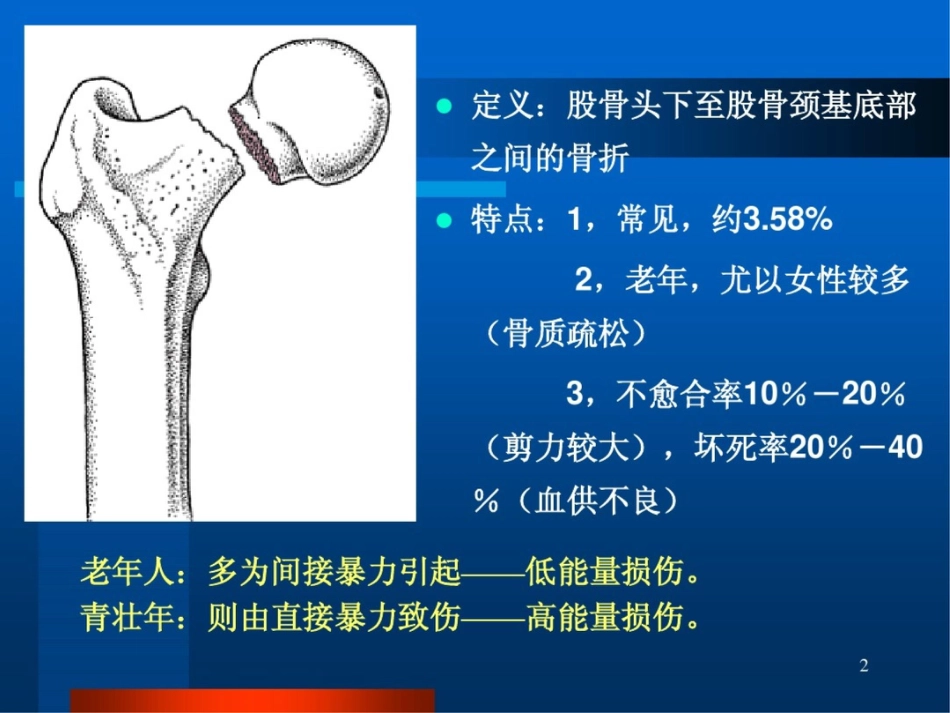 股骨颈骨折ppt课件_第2页