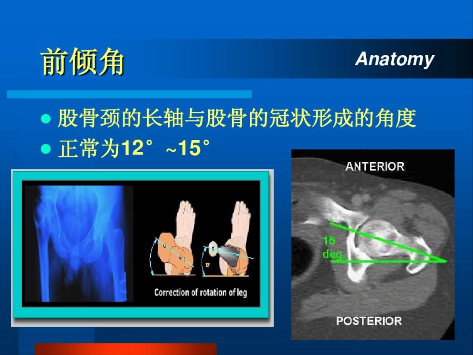 股骨颈骨折ppt课件_第4页