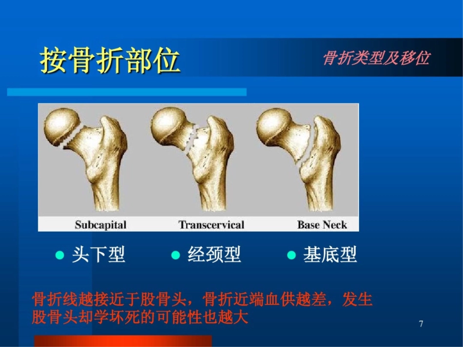 股骨颈骨折ppt课件_第7页