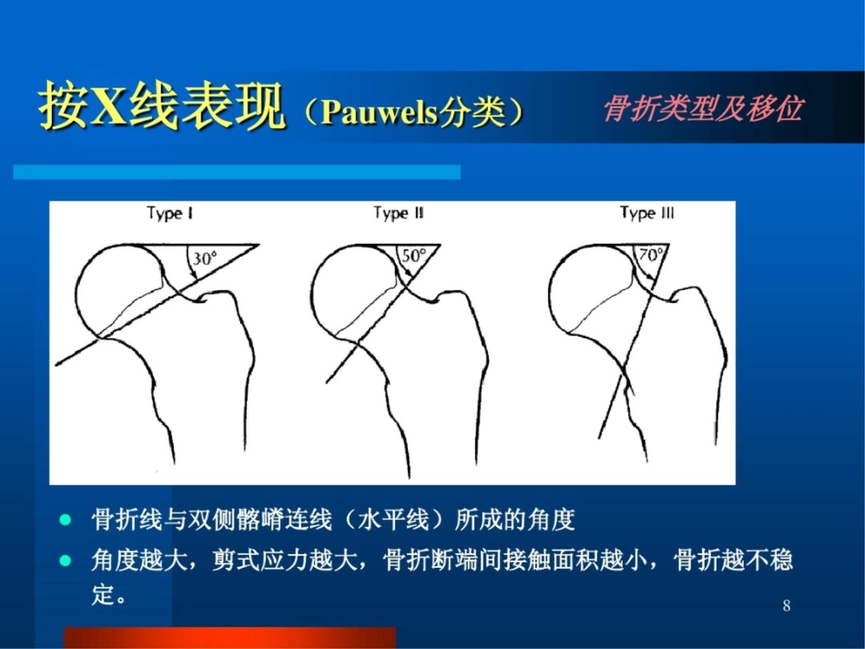 股骨颈骨折ppt课件_第8页