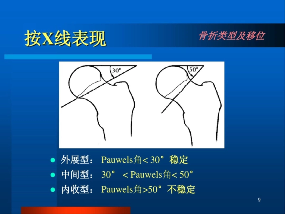 股骨颈骨折ppt课件_第9页
