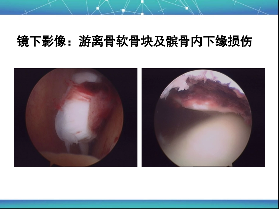 髌骨脱位_第14页