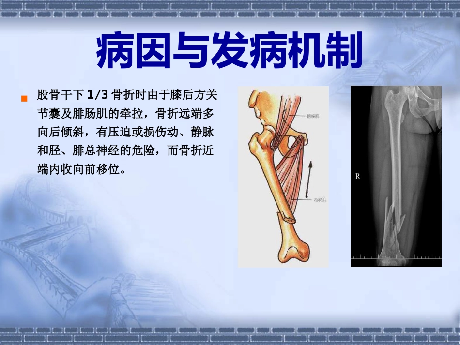股骨干骨折_第10页