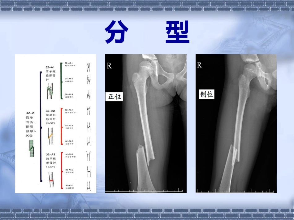 股骨干骨折_第13页
