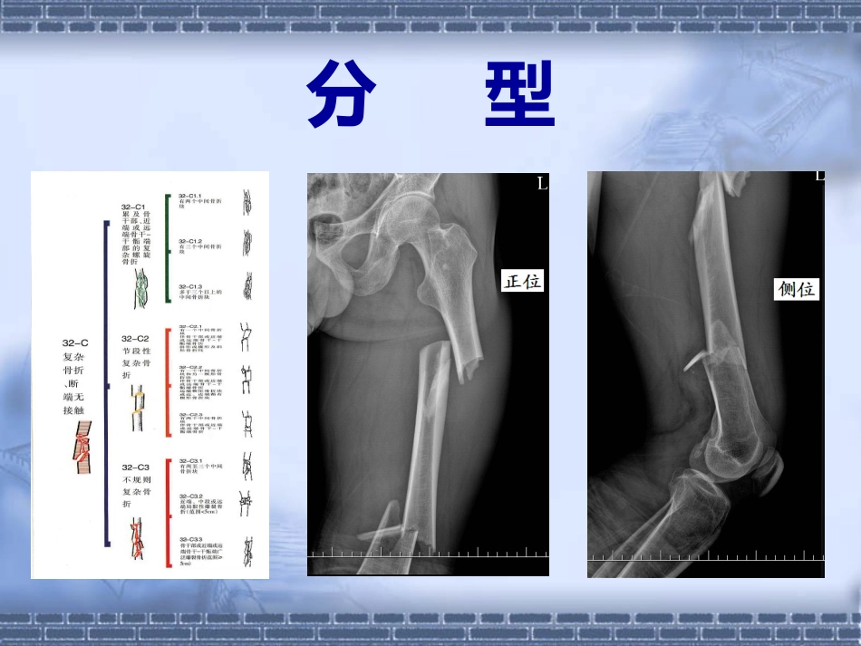 股骨干骨折_第15页