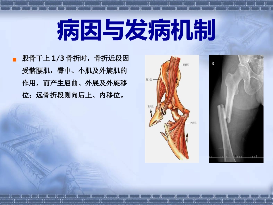股骨干骨折_第8页