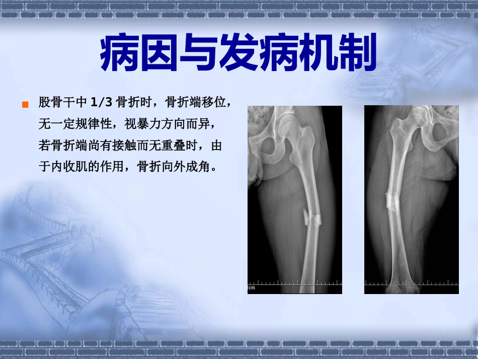 股骨干骨折_第9页