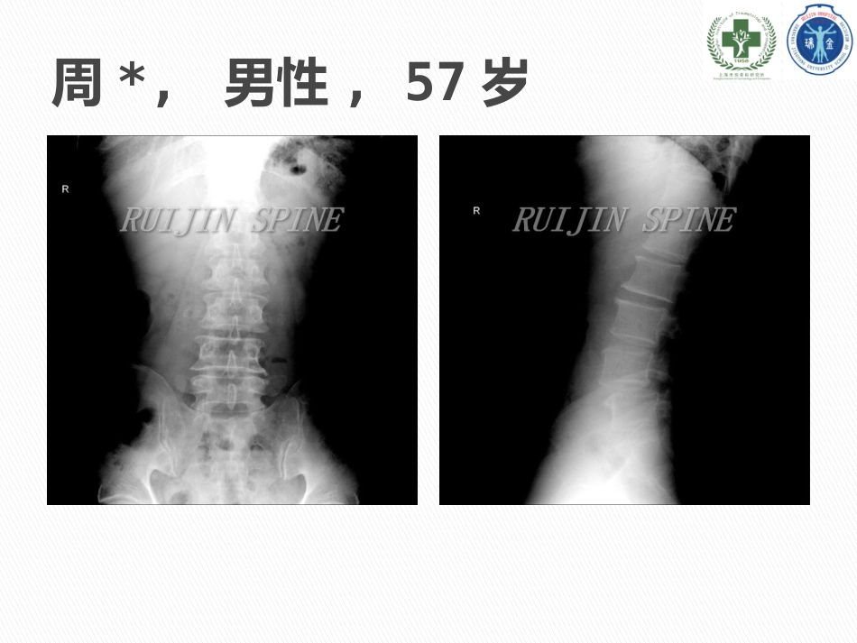 MIS-TLIF治疗腰椎峡部性滑脱_第9页