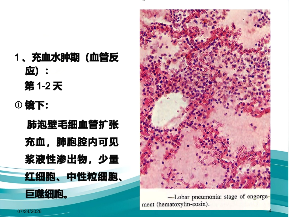 病理学 肺炎PPT课件_第14页