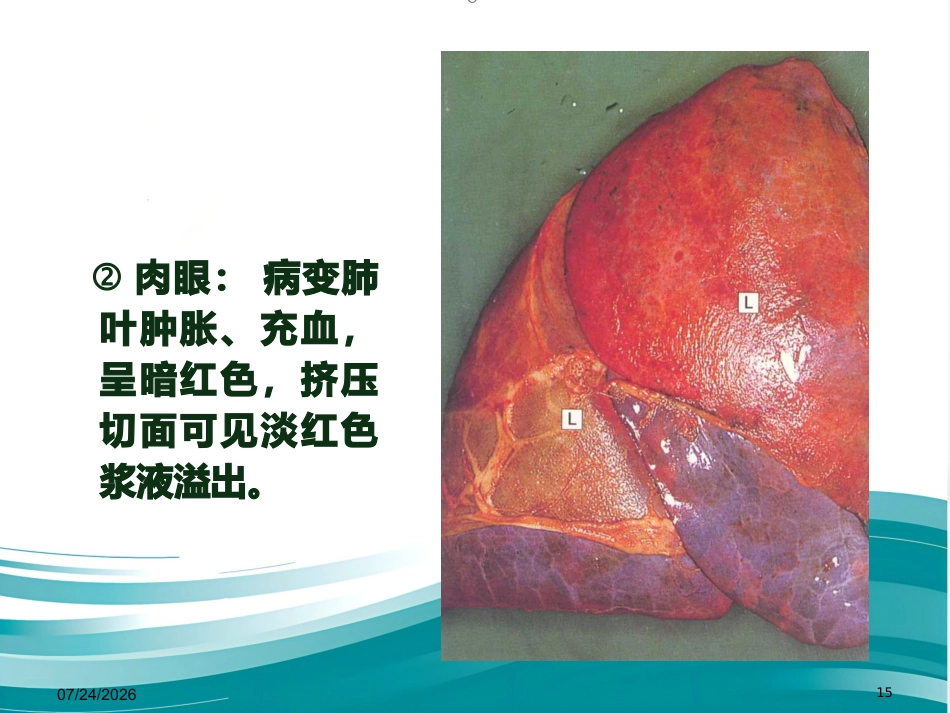 病理学 肺炎PPT课件_第15页