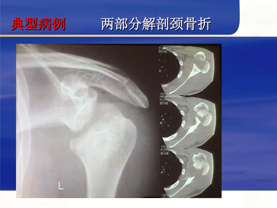 肱骨近端骨折Neer分型及治疗_第12页