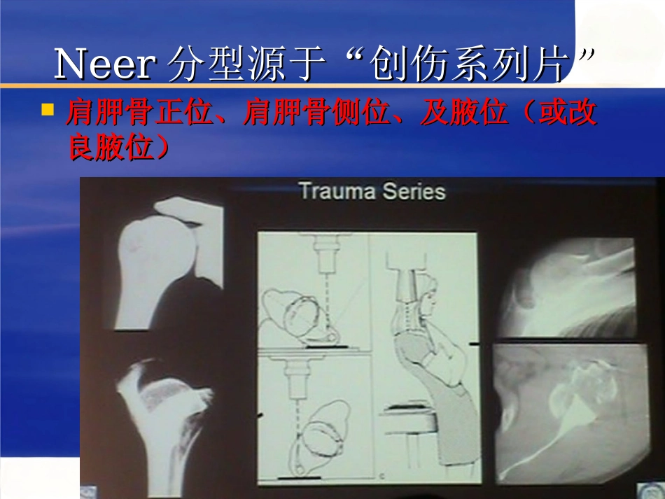 肱骨近端骨折Neer分型及治疗_第5页