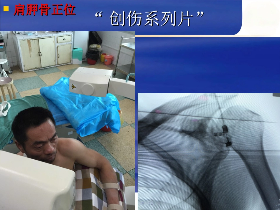 肱骨近端骨折Neer分型及治疗_第6页