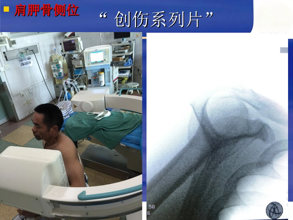 肱骨近端骨折Neer分型及治疗_第7页